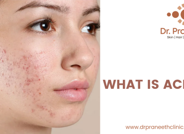 Acne: Causes, Prevention, and Effective Treatments