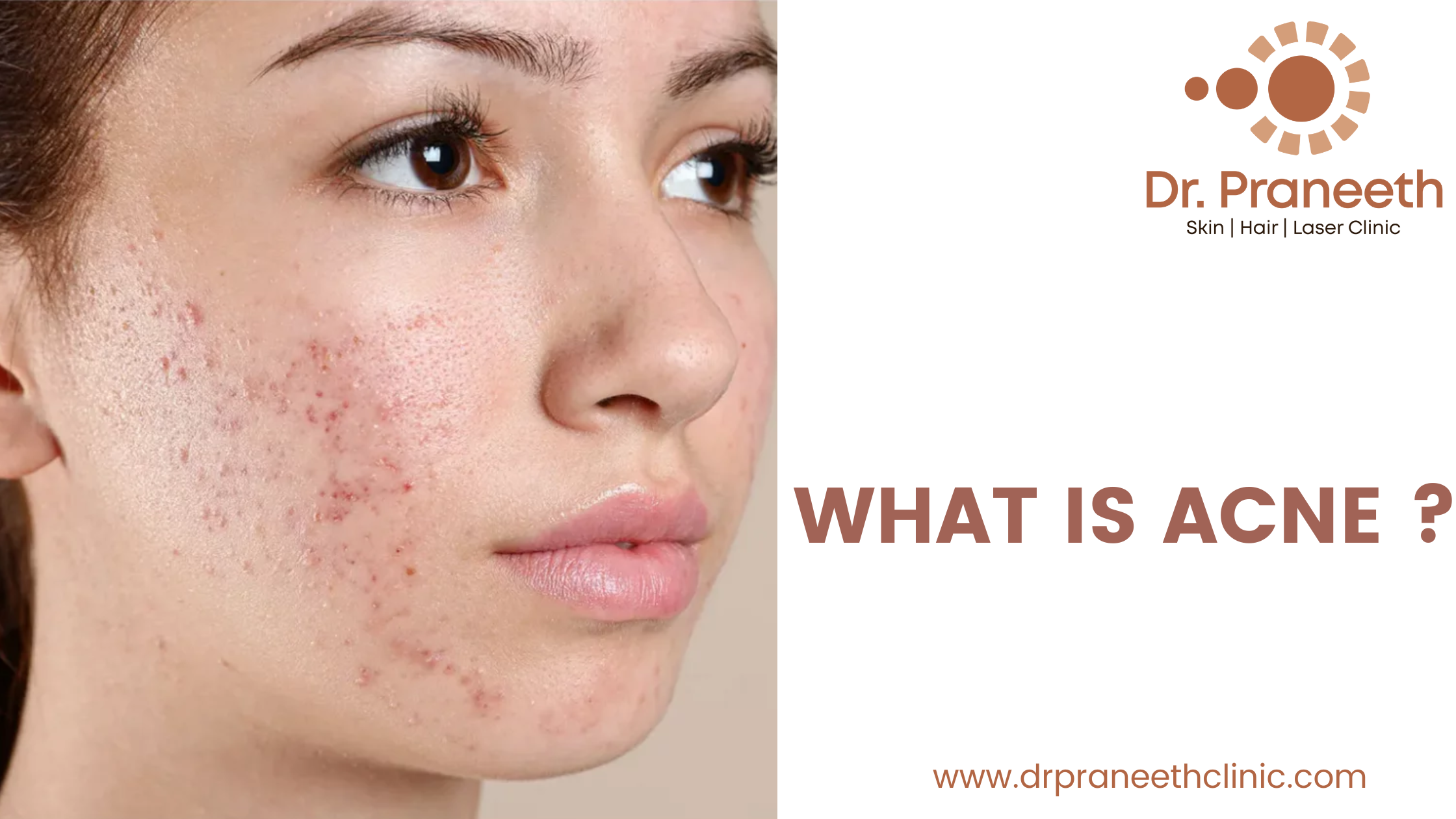 Acne: Causes, Prevention, and Effective Treatments