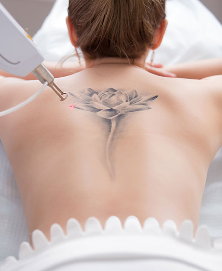 Does Laser Tattoo Remvoval Affect Body Hair  Skin